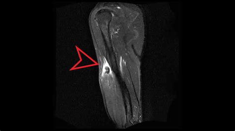 bicep tendo tear test|mri for biceps tendon rupture.